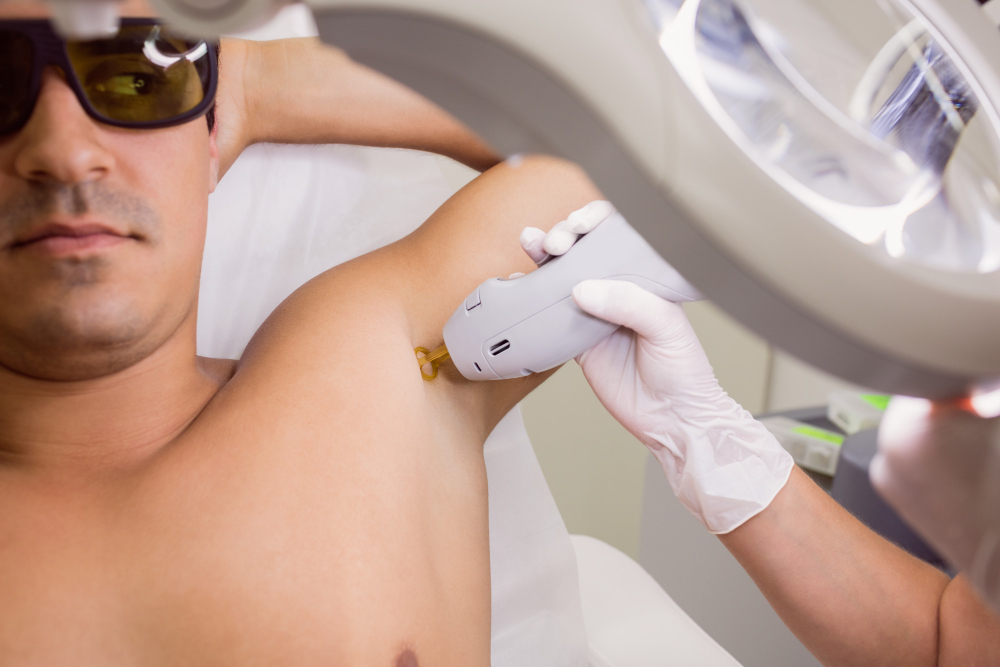 Depilação a laser para homem: vale a pena fazer?